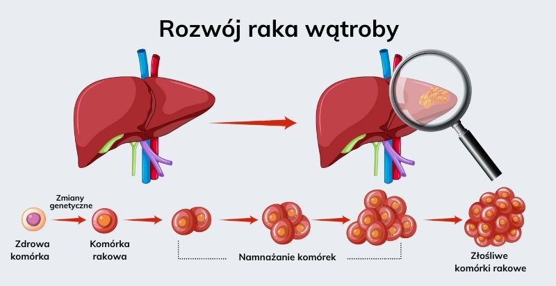 rowzój raka wątroby