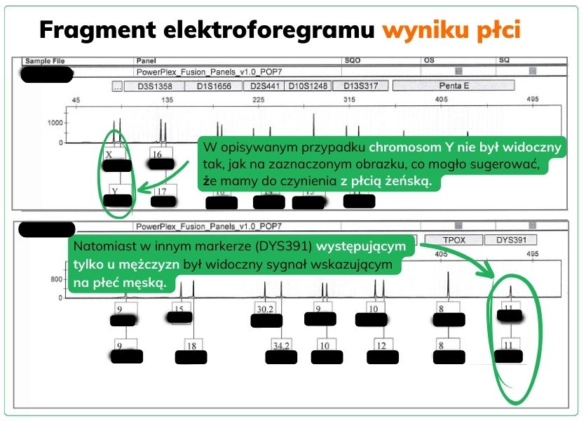 Chromosomy płci - X i Y. W opisywanym przypadku brak chromosomu Y (1)